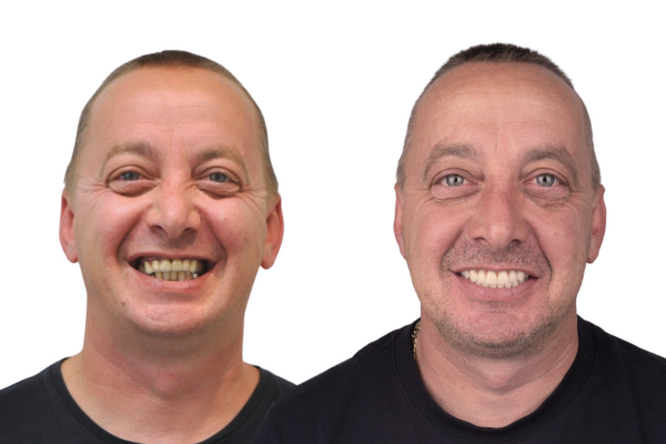 All-on-4® before and after patient